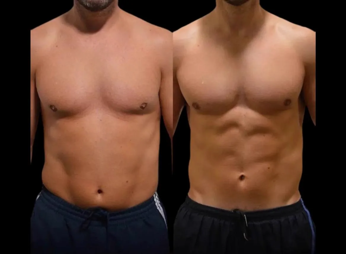 3. Advanced Liposuction Techniques image 2