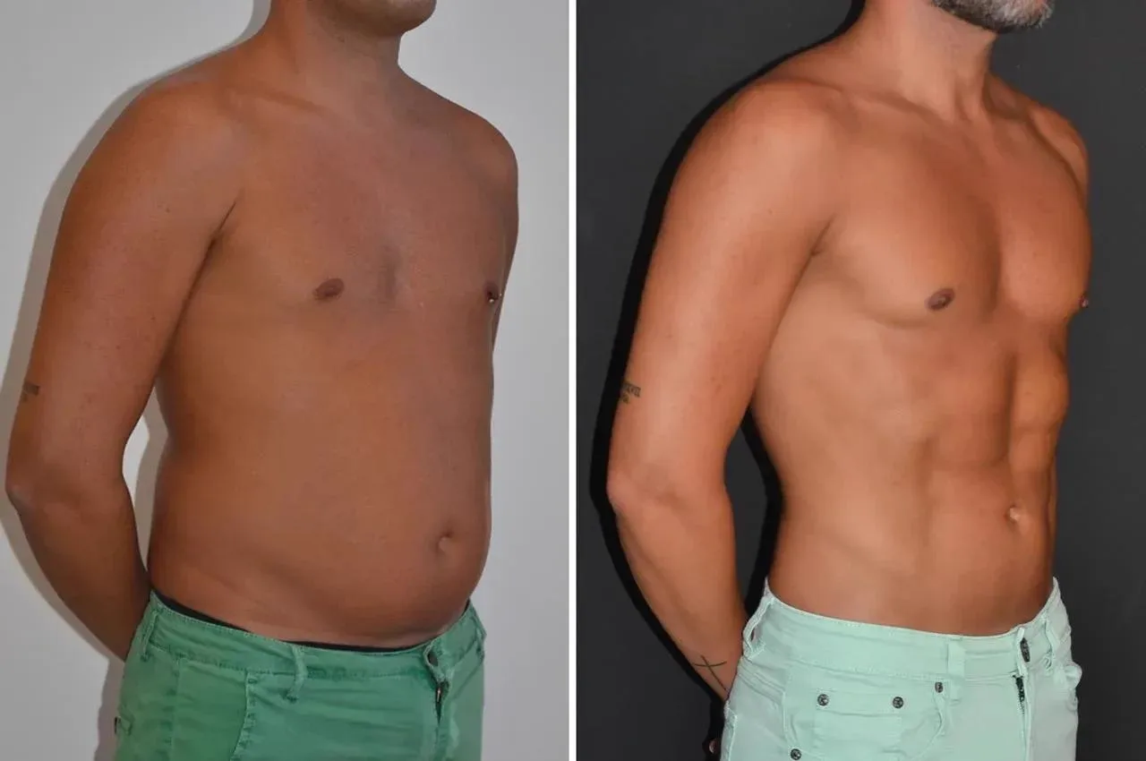 3. Advanced Liposuction Techniques image 3
