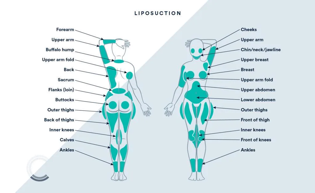 2. Areas Treated with Liposuction image 1