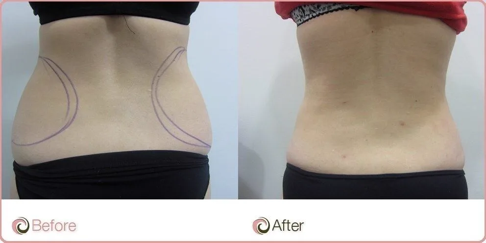 2. Areas Treated with Liposuction image 2