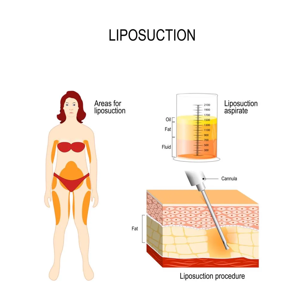 2. Areas Treated with Liposuction image 3