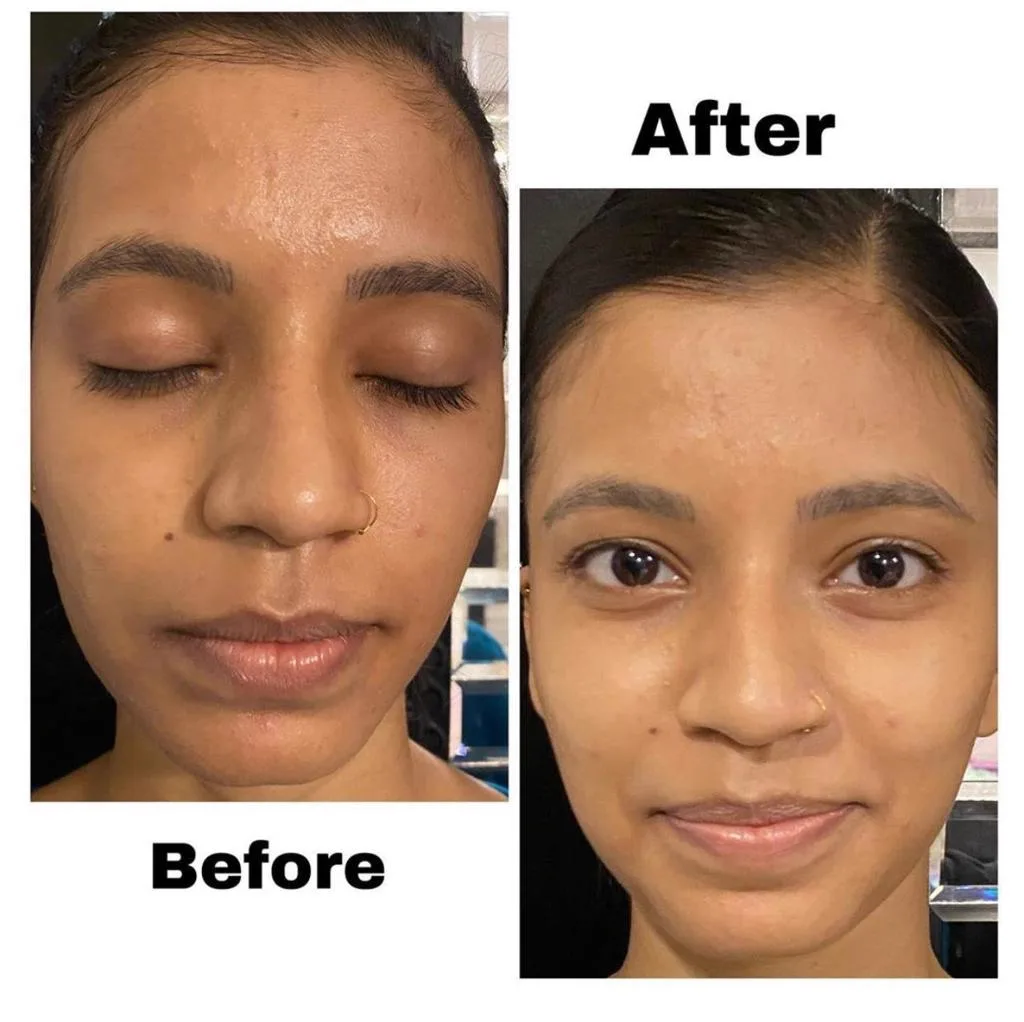4. BB Glow Treatment in Guwahati image 1