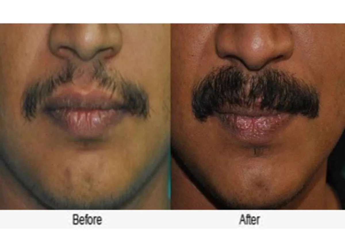 3. Beard & Moustache Hair Transplant image 1