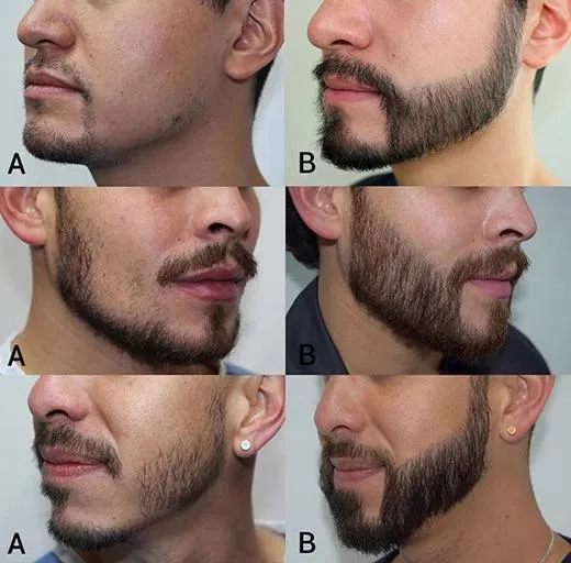 3. Beard & Moustache Hair Transplant image 2