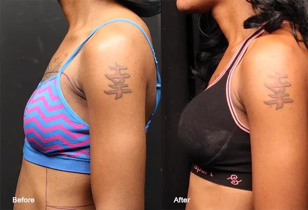 3. Breast Fat Transfer (Natural Breast Enhancement) image 1