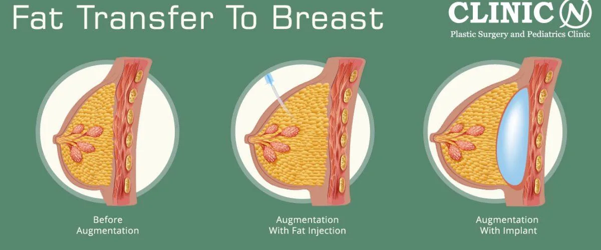 3. Breast Fat Transfer (Natural Breast Enhancement) image 2