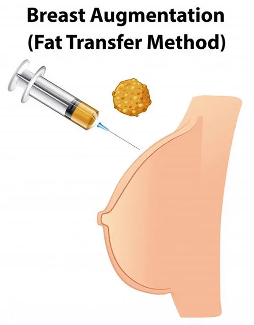 3. Breast Fat Transfer (Natural Breast Enhancement) image 3
