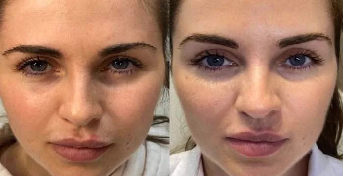 3. Brow Lift Effect (Non-Surgical) image 1
