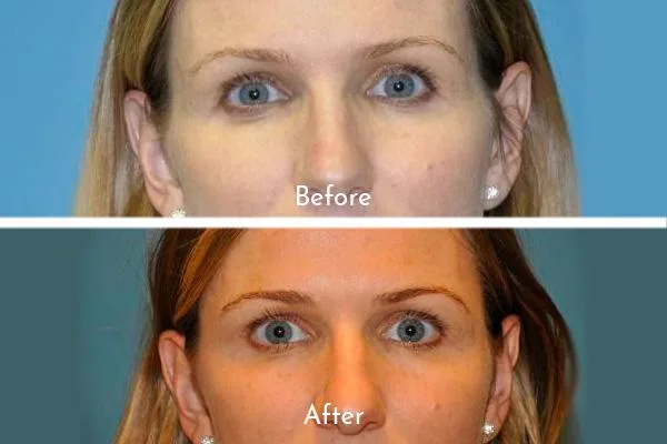 3. Brow Lift Effect (Non-Surgical) image 2