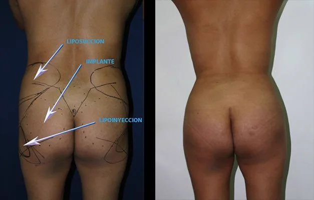 1. Butt Implants Surgery in Guwahati image 1