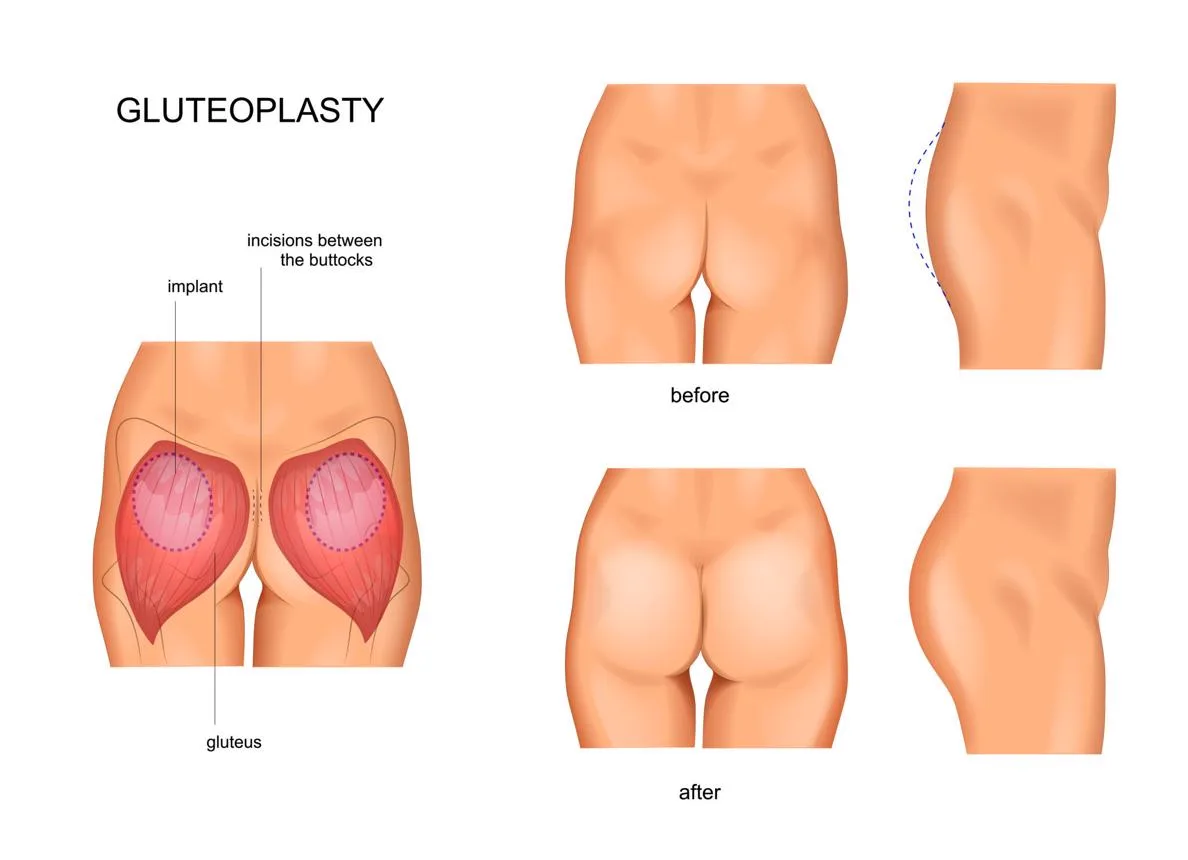 1. Butt Implants Surgery in Guwahati image 2