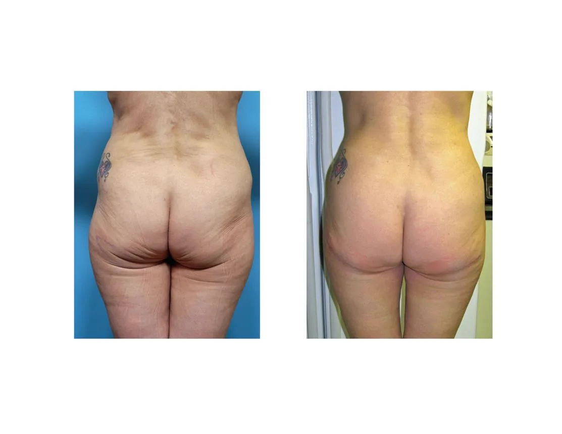 3. Butt Lift Surgery (Gluteal Lift) image 2