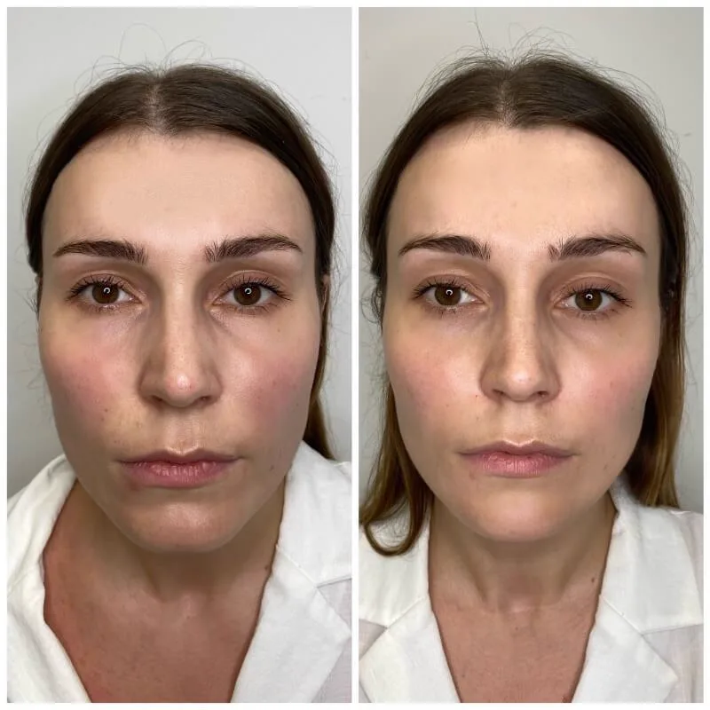 1. Chin Augmentation (Non-Surgical Chin Enhancement) image 1