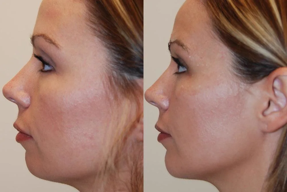 1. Chin Augmentation (Non-Surgical Chin Enhancement) image 2