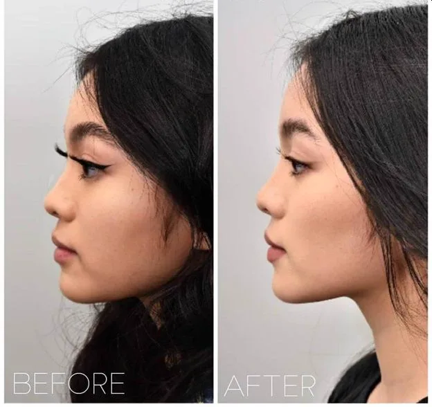 3. Chin Fillers (Profile Enhancement) image 1