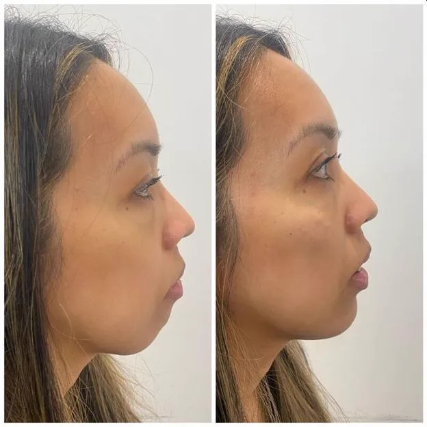3. Chin Fillers (Profile Enhancement) image 3
