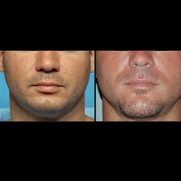 4. Chin Lengthening & Feminization / Masculinization image 1