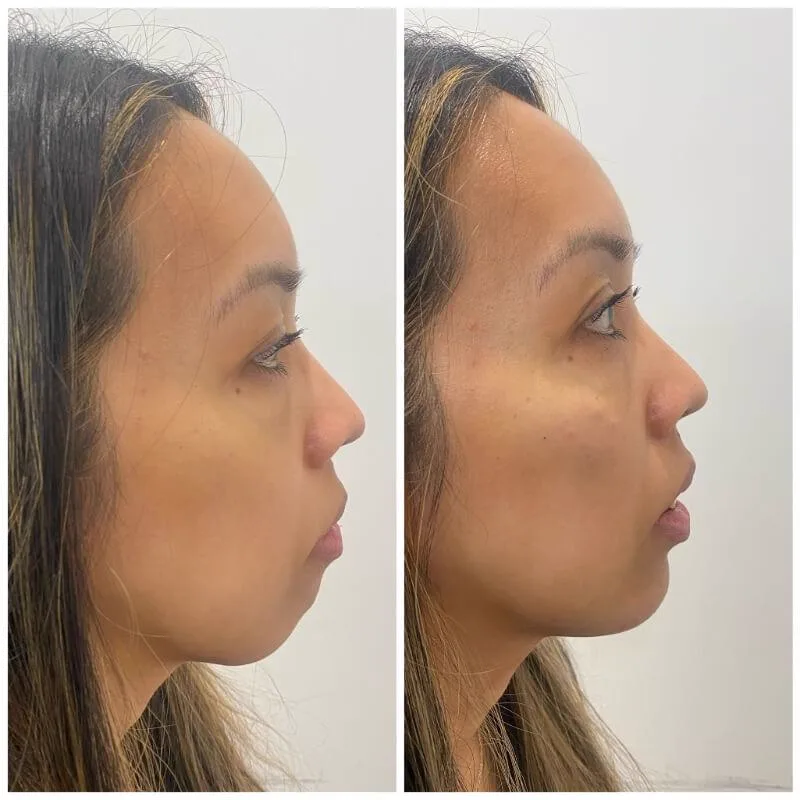 2. Chin Shape & Contour Correction image 1