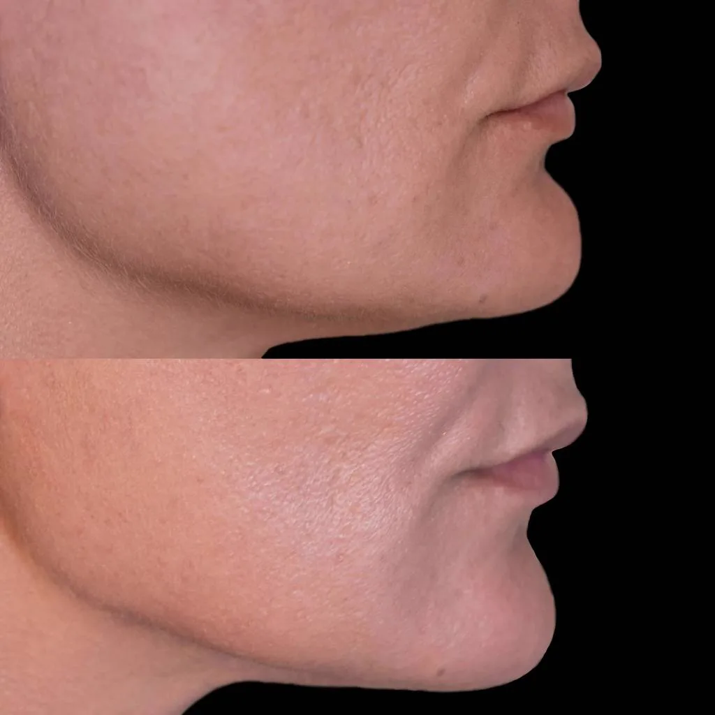 2. Chin Shape & Contour Correction image 2