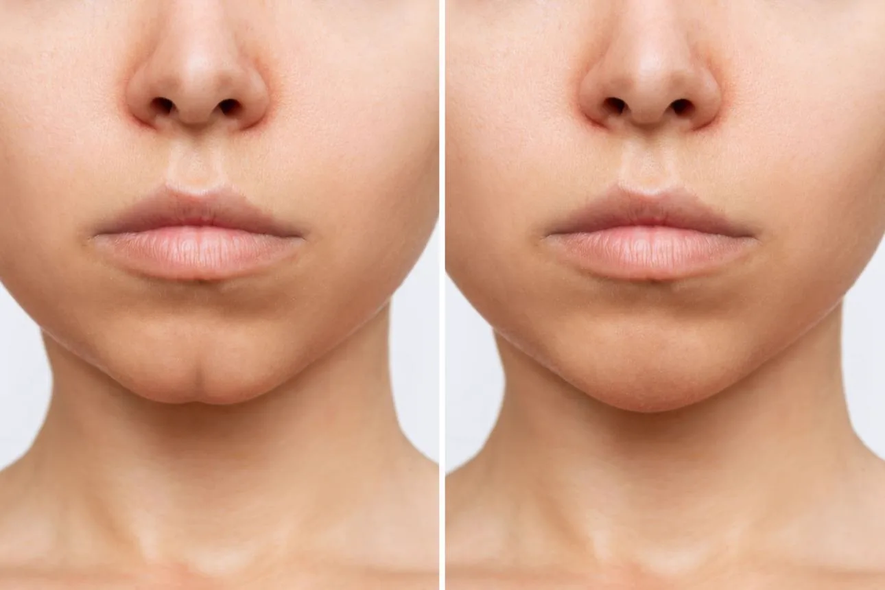 5. Chin Wrinkle & Dimple Correction (Mentalis Relaxation) image 1