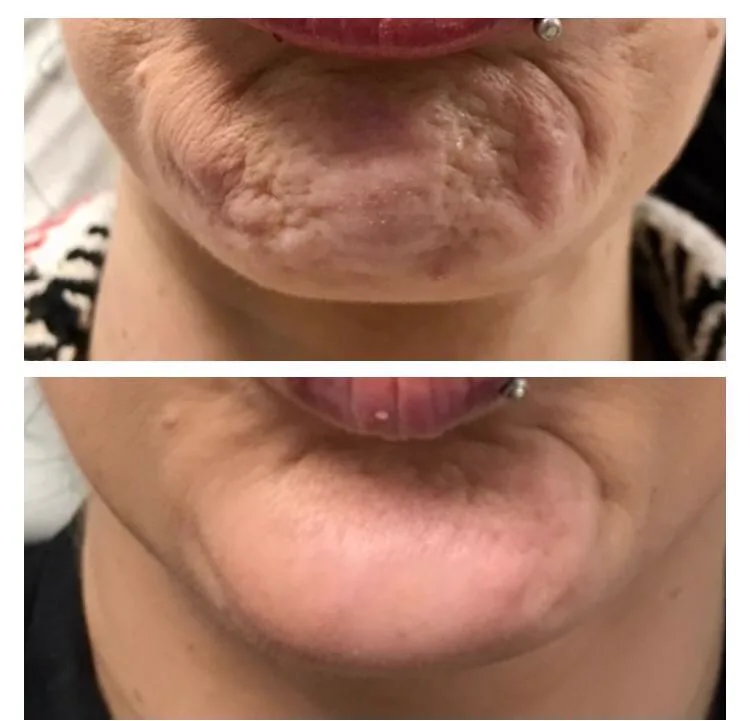 5. Chin Wrinkle & Dimple Correction (Mentalis Relaxation) image 2