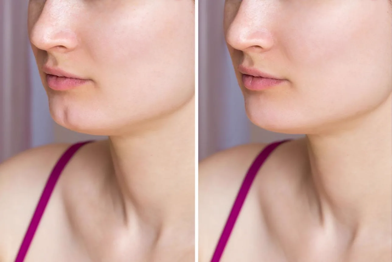 5. Chin Wrinkle & Dimple Correction (Mentalis Relaxation) image 3