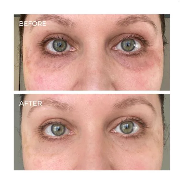6. Collagen Boost Threads (Skin Tightening Threads) image 2