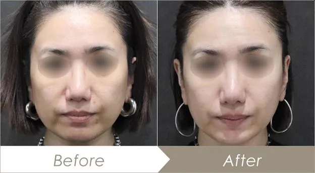 6. Collagen Boost Threads (Skin Tightening Threads) image 3
