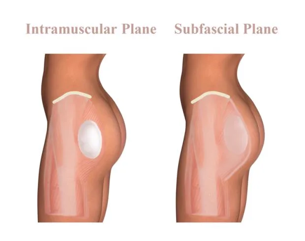 4. Combination Procedures (BBL + Implants / Lift) image 2