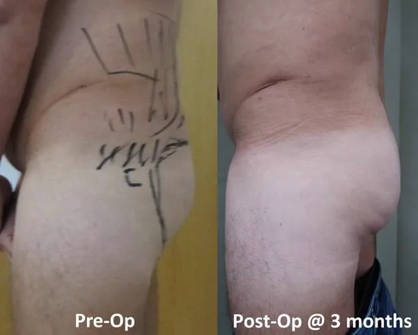 4. Combination Procedures (BBL + Implants / Lift) image 3