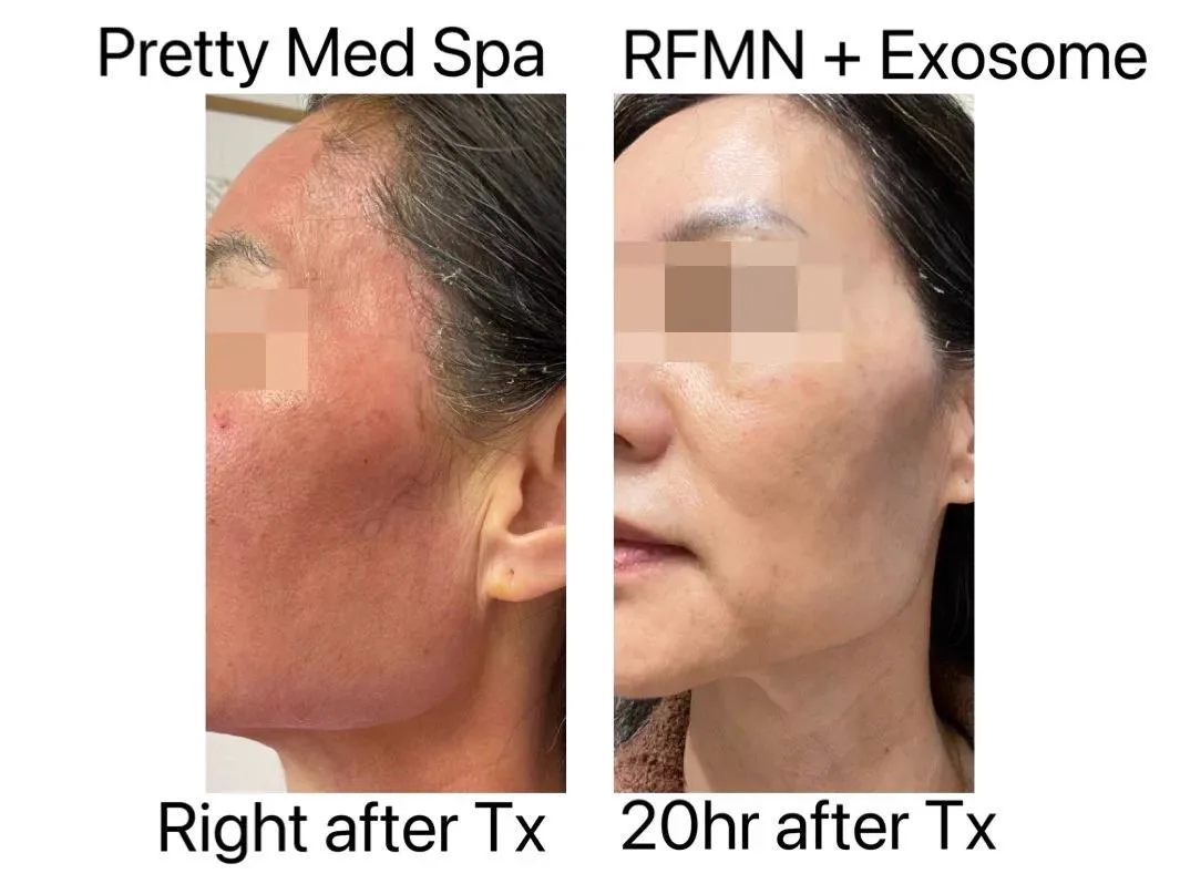 5. Combination Treatments (Exosomes + Microneedling / MNRF) image 2