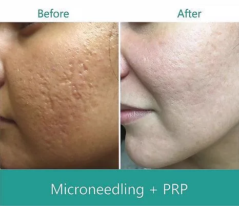 5. Combination Treatments (MNRF + PRP / Exosomes) image 1