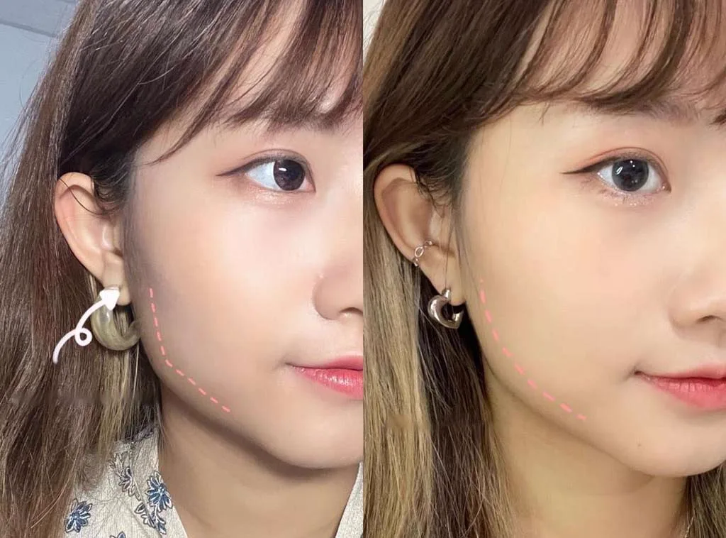 4. Combination Treatments (Masseter Botox + Jawline Fillers) image 3