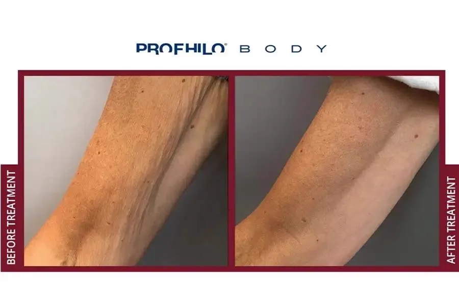 5. Combination Treatments (Profhilo + Botox / Fillers / MNRF) image 2