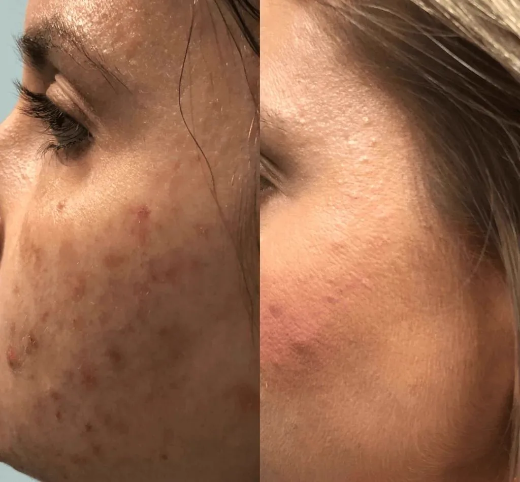 6. Combination Treatments (Skin Boosters + Microneedling / Laser) image 3