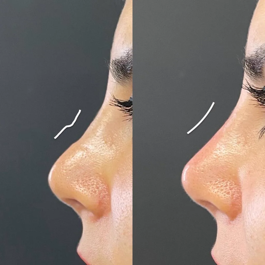 4. Correction of Dorsal Hump & Irregularities image 2