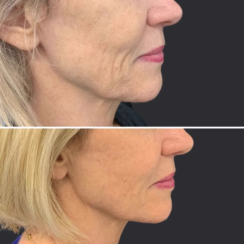 4. Correction of Sagging Jawline & Jowls image 1