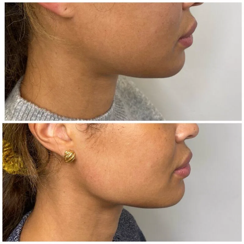 4. Correction of Sagging Jawline & Jowls image 3