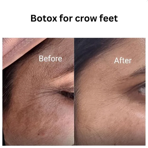 3. Crow's Feet (Eye Wrinkles)