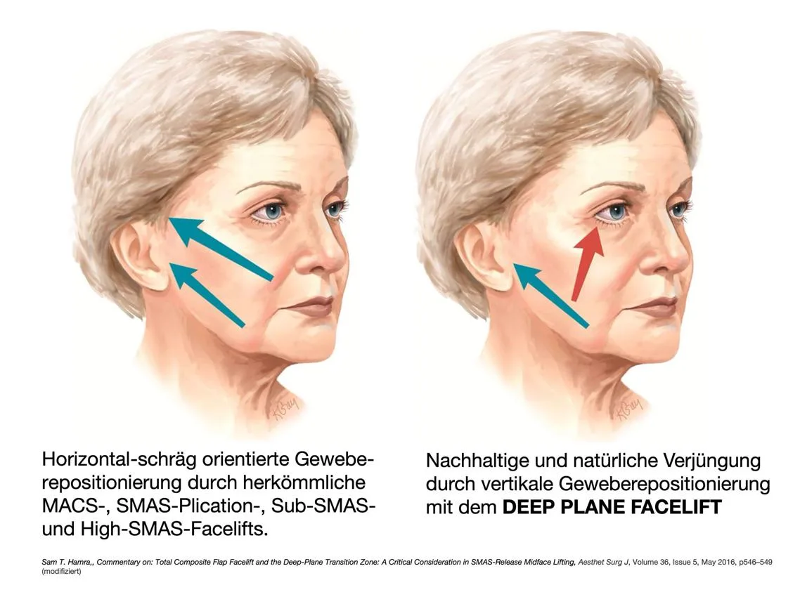 4. Deep Plane Facelift (Advanced Technique) image 1