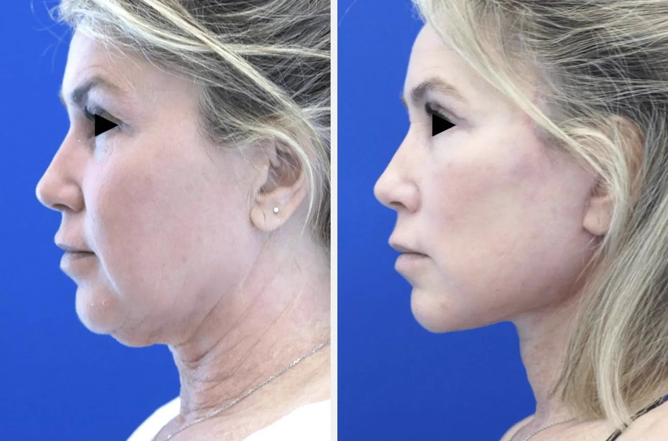 4. Deep Plane Facelift (Advanced Technique) image 2