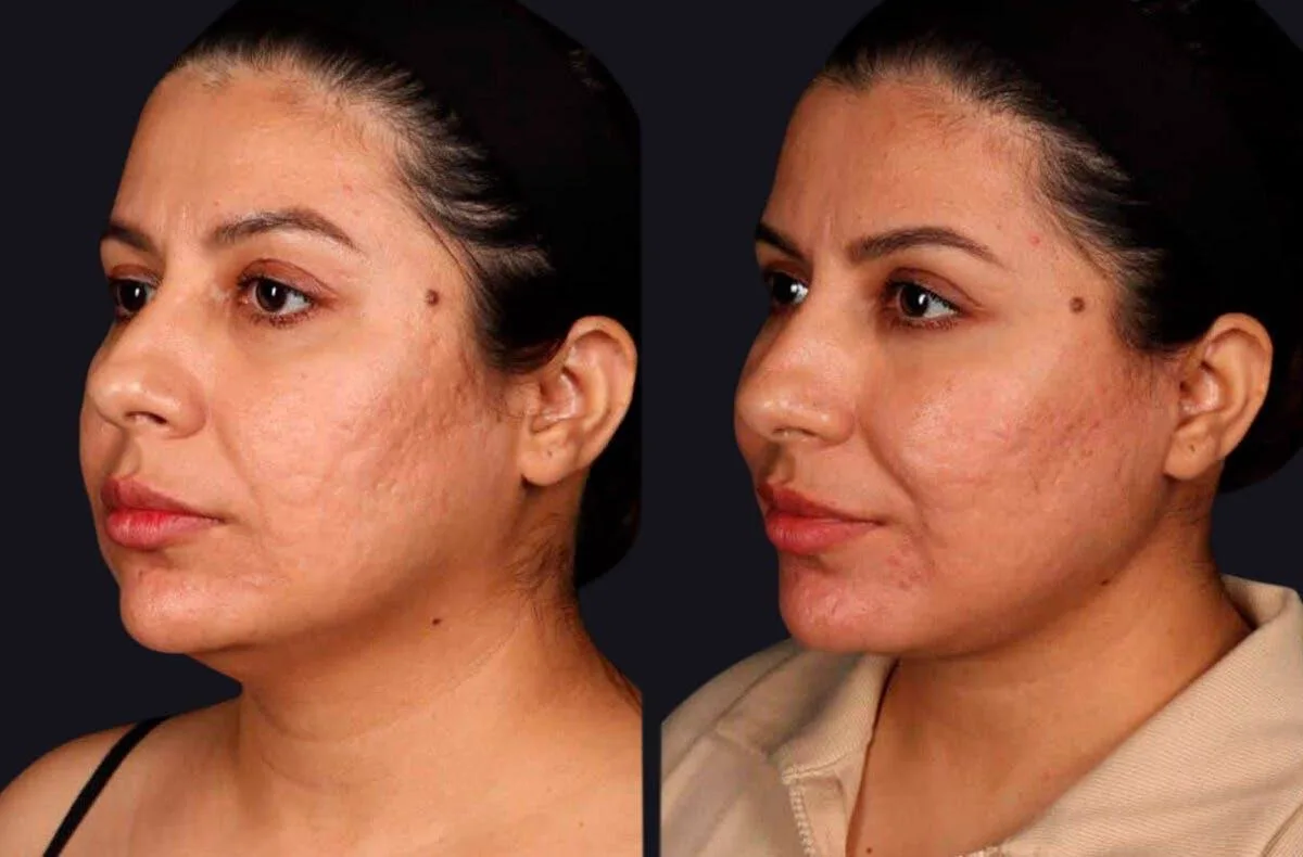 4. Deep Plane Facelift (Advanced Technique) image 3