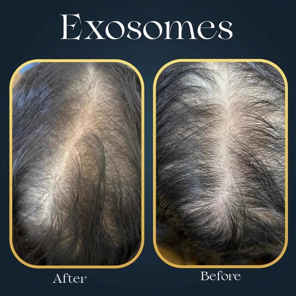 3. Exosome Therapy for Hair Regrowth image 2