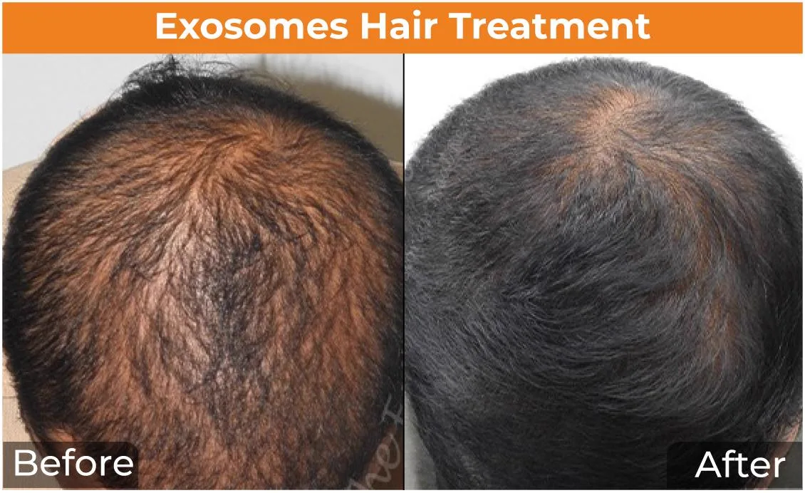 3. Exosome Therapy for Hair Regrowth image 3