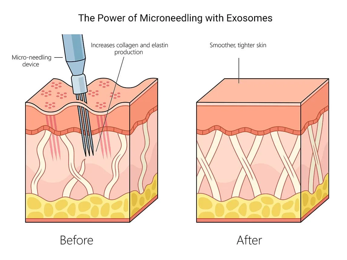 4. Exosome Therapy for Skin Rejuvenation image 1