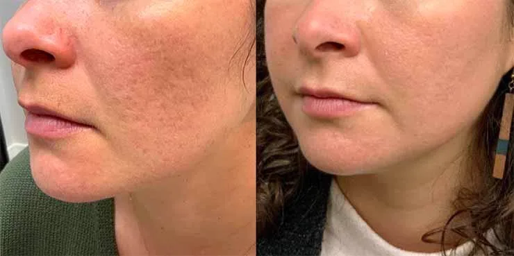 4. Exosomes for Acne Scars & Skin Repair image 1