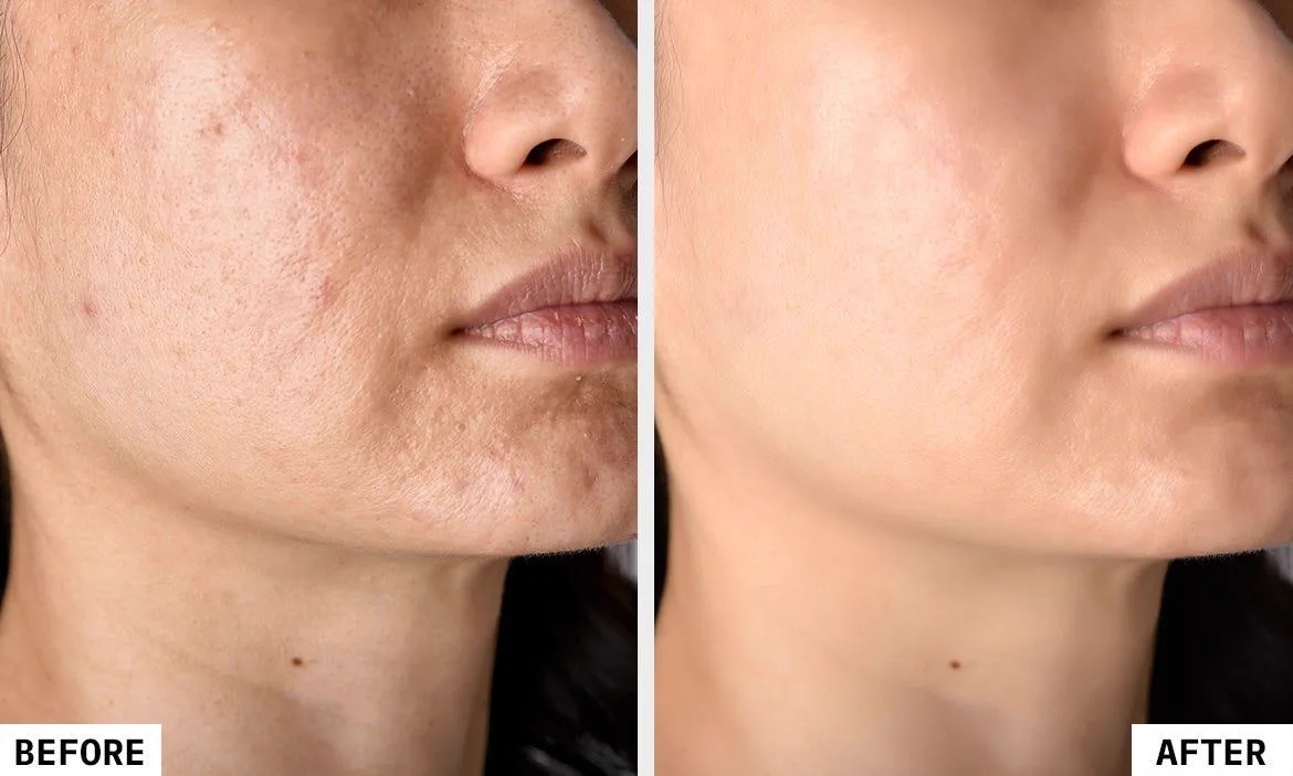 4. Exosomes for Acne Scars & Skin Repair image 3
