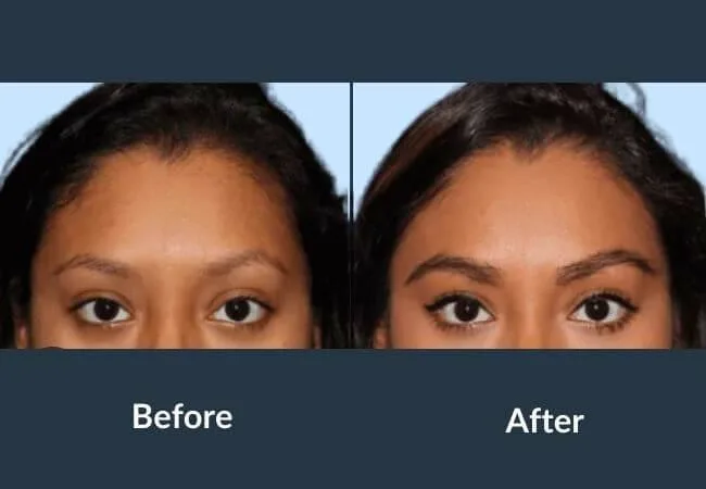 4. Eyebrow Hair Transplant image 1