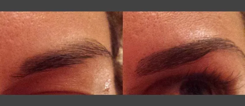 4. Eyebrow Hair Transplant image 2