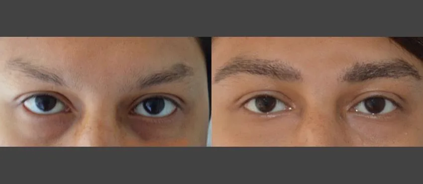 4. Eyebrow Hair Transplant image 3